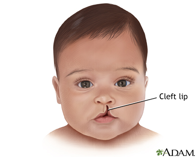 Cleft Lip Illustration
